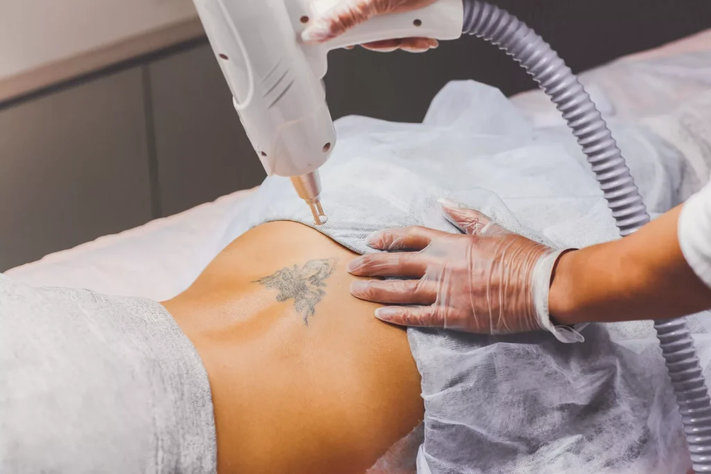 5 Signs It’s Finally Time to Remove That Tattoo